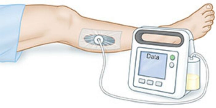 دستگاه وکیوم تراپی زخم مدل Simplex II